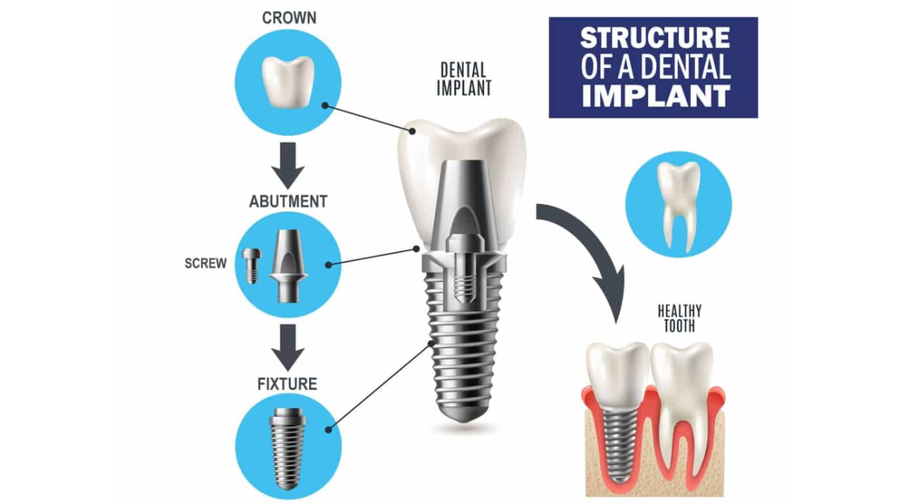 implant structure