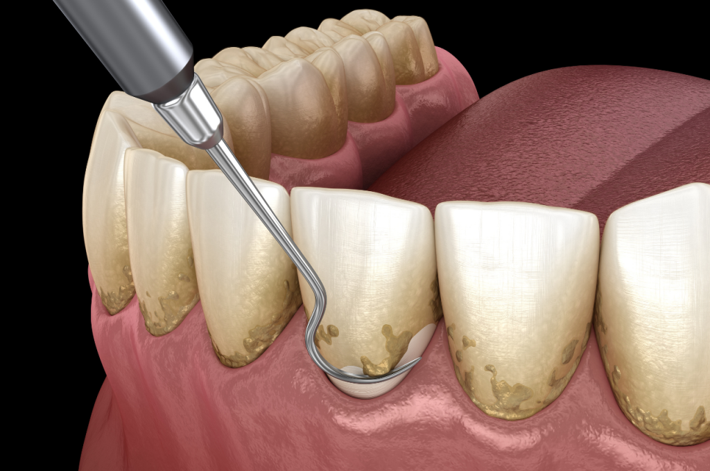 Gum Disease Treatment