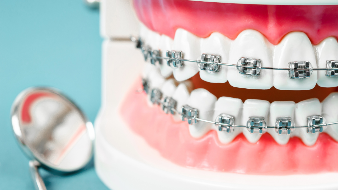 Dental Braces